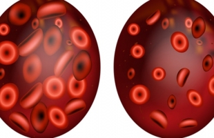 اختبار دم يمكنه اكتشاف 12 نوعًا من السرطان