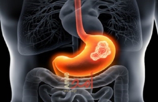 6 طرق مدعومة علميًا لتخفيف حرقة المعدة دون أدوية