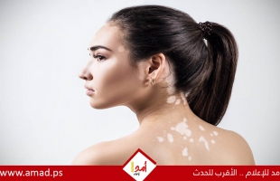 الأعراض وطرق التعامل مع مرض البهاق