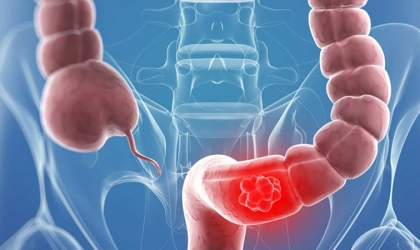 سرطان القولون.. أعراض ظاهرة لا تتجاهلها وأسباب الإصابة