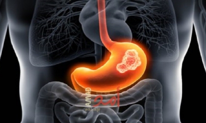 5 علامات لسرطان القولون تظهر على الجلد